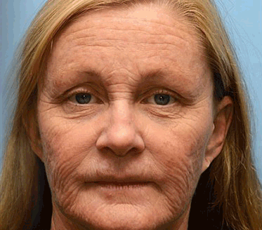 FrissArc™ Крем против бръчки с пептиди от пчелна отрова – Намалява бръчките, стяга кожата и изравнява тена.